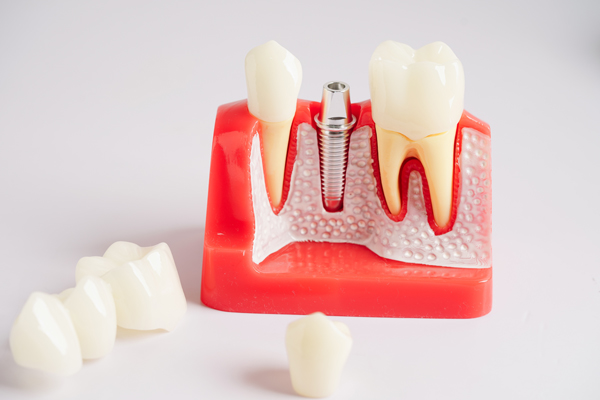 Sinus Augmentation For Dental Implants
