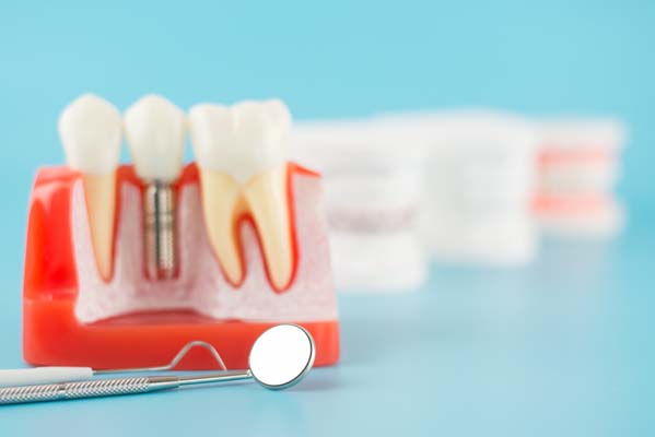 How To Take Care Of Dental Implants 