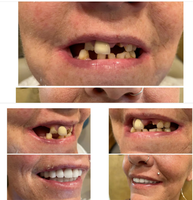 Before-and-after photos of a patient treated by Dr. Klele (case 1)