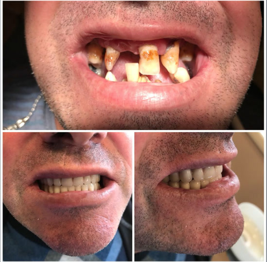 Before-and-after photos of a patient treated by Dr. Klele (case 2)